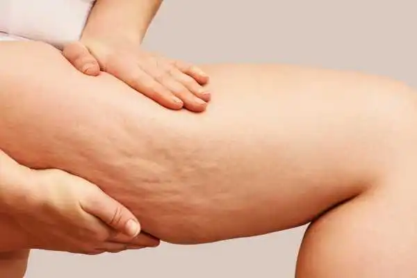 Image of woman showing leg with cellulite St George