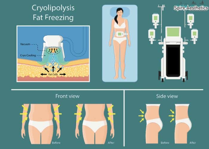 Image of diet and fat freezing combined for best results for Spire Aesthetics St George